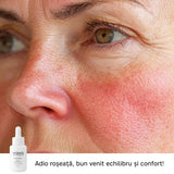 DermaSolutions Booster Rozacee/Cuperoză 100% molecular skincare - Wawa Fresh Cosmetics